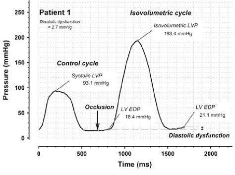 lv pressure trace|allows estimation of the left ventricular pressure trace area.